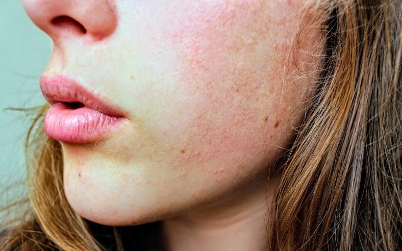 Skincare Untuk Kulit Kering