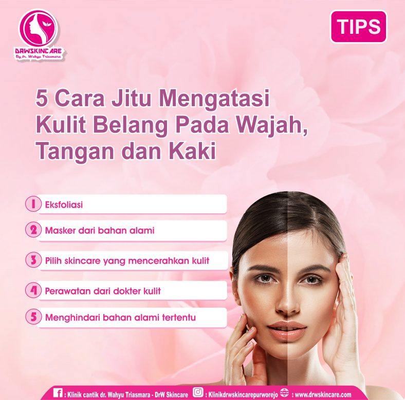 5 Cara Jitu Mengatasi Kulit Belang Pada Wajah, Tangan dan Kaki